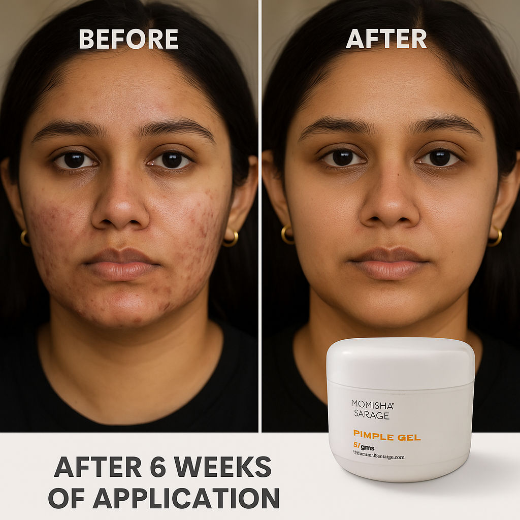 Pimple gel | For Active Acne | 50gms