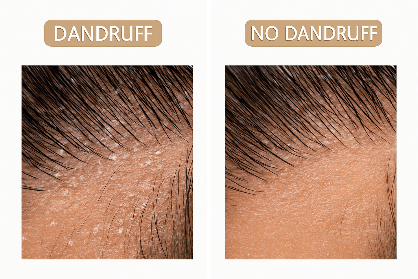 Anti dandruff gel | Controls dandruff and itchy scalp | 50gms