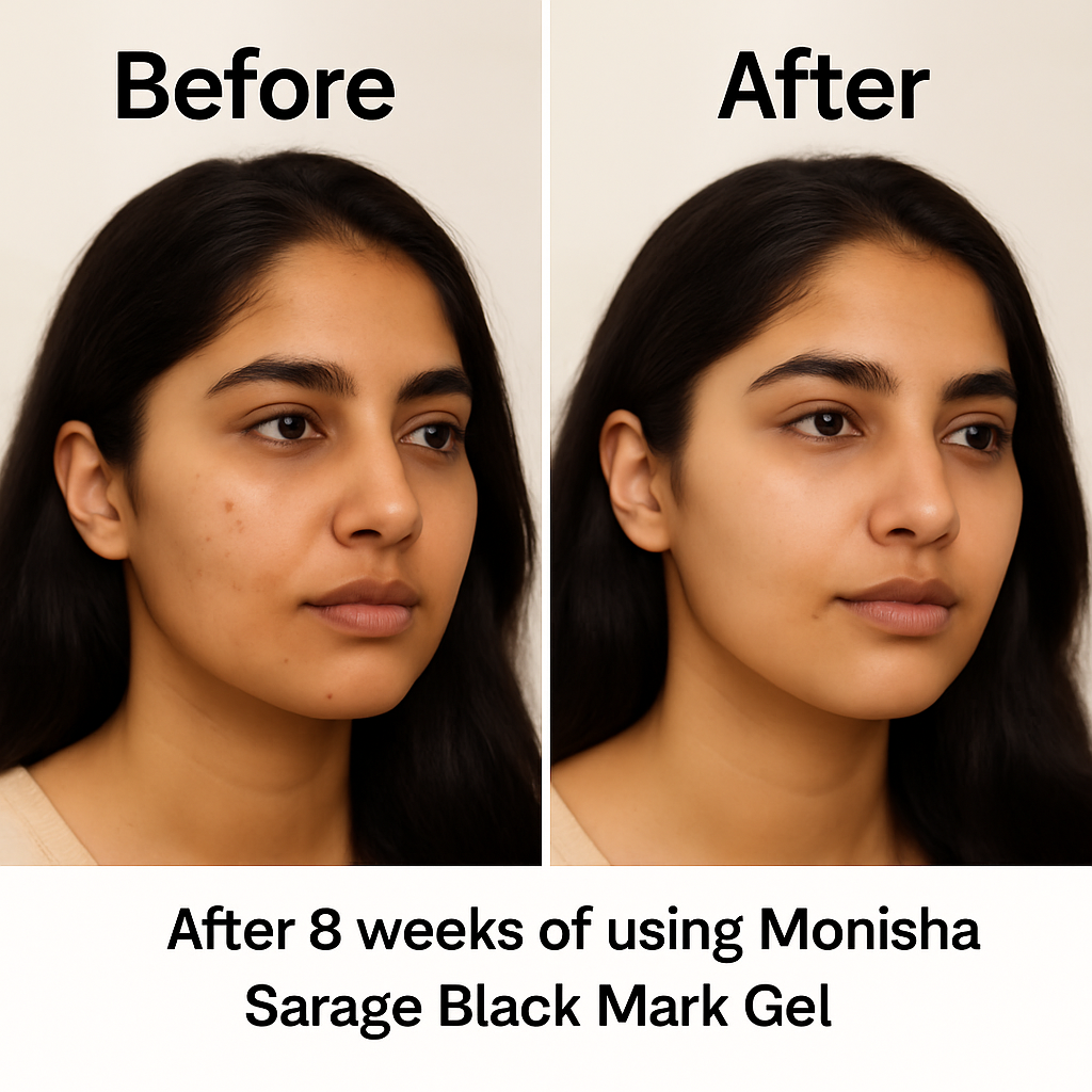 Black mark gel | For Dark Underarms | For old acne marks | 50gms