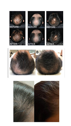 Hair growth serum | Severe hairfall control | Controls balding | 30ml